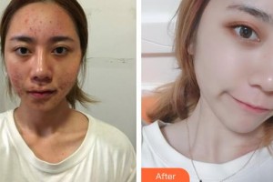 荊州普愛康復(fù)醫(yī)院彭義坤整形價格表附紅藍光祛痘案例展示