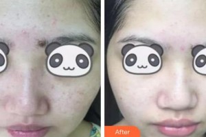 荊州中愛醫(yī)療整形美容門診部楊明明整形價格表附黑臉娃娃案例展示