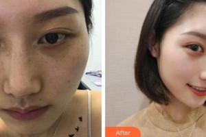 荊州中愛醫(yī)療整形美容門診部陳志鵬整形價格表附紅藍光祛痘案例展示