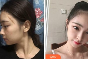 荊州普愛康復(fù)醫(yī)院聶忠整形價格表附激光祛疤案例展示