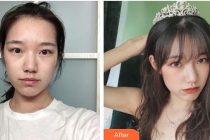 荊州美傲醫(yī)療美容診所黃誠斌整形價格表附微創(chuàng)疤痕修復(fù)案例展示