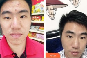 荊州市第二人民醫(yī)院整形激光美容中心劉兵整形價格表附紅藍光祛痘案例展示