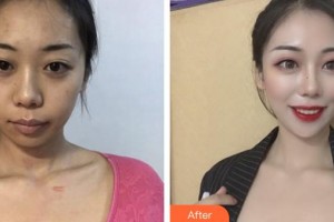 荊州華夏眼科醫(yī)院王海波整形價格表附眼部綜合案例展示