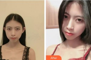 荊州華美整形美容醫(yī)院倪彬整形價格表附切開雙眼皮案例展示