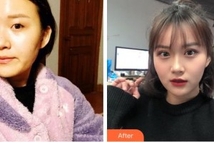 荊州華夏眼科醫(yī)院羅中華整形價格表附切開雙眼皮案例展示