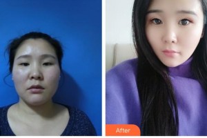 荊州華夏眼科醫(yī)院黃毅整形價格表附眼部綜合案例展示