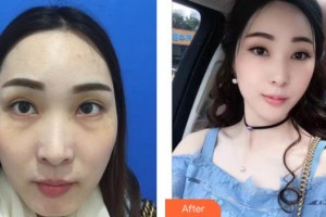 荊州普愛康復(fù)醫(yī)院包濤整形價格表附切開雙眼皮案例展示