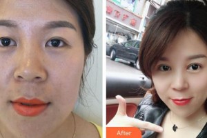 荊州愛(ài)爾眼科醫(yī)院胡淑瓊整形價(jià)格表附埋線雙眼皮案例展示