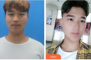 荊州市婦幼保健院眼科杜東成整形價(jià)格表附切開(kāi)雙眼皮案例展示