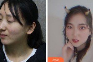 荊州市婦幼保健院眼科駱順發(fā)整形價(jià)格表附激光去眼袋案例展示