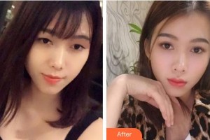 荊州愛爾眼科醫(yī)院凃惠芳整形價格表附眼部綜合案例展示