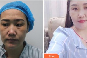 荊州華夏眼科醫(yī)院徐鳴整形價格表附外切祛眼袋案例展示