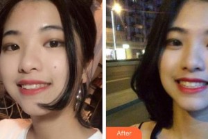 荊州公安縣楚星口腔門(mén)診胡歡歡整形價(jià)格表附牙齒隱形矯正案例展示