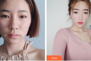 黃岡皇氏醫(yī)療美容醫(yī)院王全俊整形價格表附埋線提升案例展示