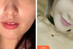 黃岡皇氏醫(yī)療美容醫(yī)院王金州整形價格表附埋線提升案例展示