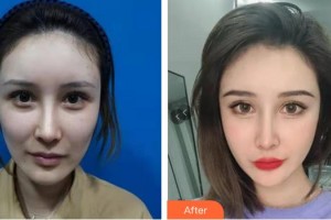 黃岡皇氏醫(yī)療美容醫(yī)院王海平整形價格表附埋線提升案例展示