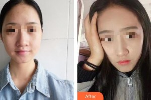 黃岡皇氏醫(yī)療美容醫(yī)院丁毅整形價格表附熱拉提案例展示