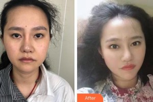 黃岡韓美醫(yī)療美容診所馮先才整形價格表附埋線提升案例展示