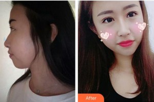 黃岡愛爾眼科醫(yī)院張麗整形價格表附眼部綜合案例展示