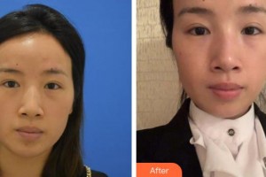 黃岡愛爾眼科醫(yī)院方敏整形價格表附激光去眼袋案例展示