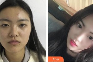 黃岡愛爾眼科醫(yī)院高小峰整形價格表附切開雙眼皮案例展示