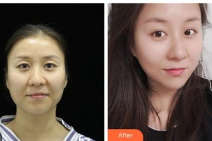 黃岡愛爾眼科醫(yī)院朱益祥整形價格表附切開雙眼皮案例展示