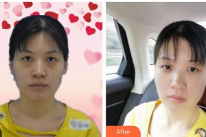 黃岡愛爾眼科醫(yī)院馮桂鳳整形價格表附激光去眼袋案例展示