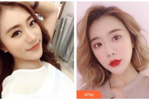 黃岡愛爾眼科醫(yī)院汪萍整形價格表附開外眼角案例展示