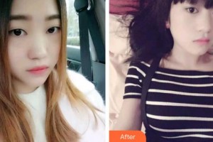 黃岡皓雅口腔醫(yī)院劉明文整形價格表附金屬托槽矯正案例展示