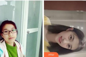 黃岡皓雅口腔醫(yī)院馮其輝整形價格表附金屬托槽矯正案例展示