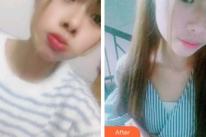 黃岡皓雅口腔醫(yī)院夏宣童整形價格表附根管調(diào)節(jié)案例展示