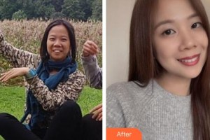 黃岡皓雅口腔醫(yī)院馮杰整形價格表附金屬托槽矯正案例展示