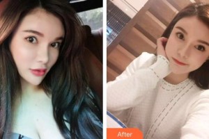 黃岡皓雅口腔醫(yī)院陳倩整形價格表附超聲波潔牙案例展示