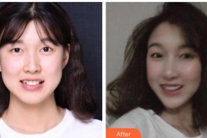 黃岡皓雅口腔醫(yī)院涂玲整形價格表附牙齒隱形矯正案例展示