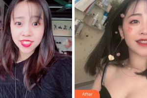 黃岡皓清口腔門診部聶文平整形價格表附金屬托槽矯正案例展示