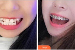 黃岡皓雅口腔醫(yī)院付亮整形價格表附金屬托槽矯正案例展示