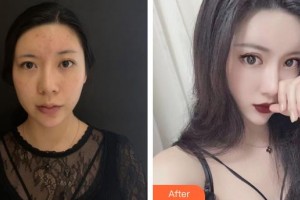 黃岡市中醫(yī)醫(yī)院燒傷整形科謝彬整形價格表附埋線提升案例展示