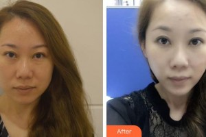 黃岡市中醫(yī)醫(yī)院燒傷整形科范聲強整形價格表附埋線提升案例展示