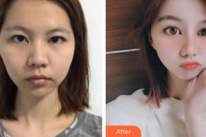 黃岡市中醫(yī)醫(yī)院燒傷整形科方華整形價格表附熱拉提案例展示