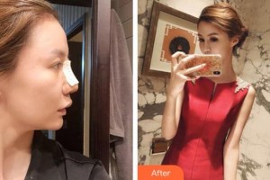 隨州市中心醫(yī)院醫(yī)學美容科鄧茜整形價格表附墊鼻基底案例展示