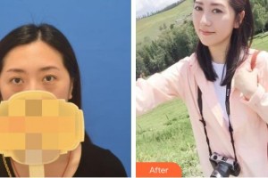 隨州愛爾眼科醫(yī)院李年爽整形價格表附開內眼角案例展示