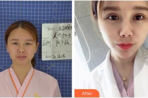 隨州愛爾眼科醫(yī)院唐亮整形價格表附眼部綜合案例展示