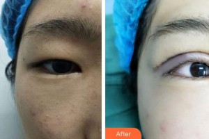 隨州愛爾眼科醫(yī)院姚大權整形價格表附切開雙眼皮案例展示