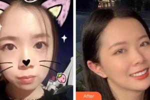 隨州泰康拜博口腔醫(yī)院劉輝整形價格表附金屬托槽矯正案例展示