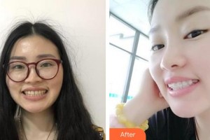 隨州泰康拜博口腔醫(yī)院羅永紅整形價格表附金屬托槽矯正案例展示