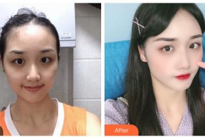 咸寧韓美醫(yī)療美容醫(yī)院廖海洋整形價格表附埋線提升案例展示