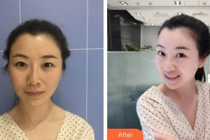 咸寧市中心醫(yī)院醫(yī)學美容中心周朝暉整形價格表附埋線提升案例展示