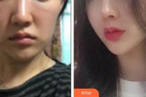 咸寧安美醫(yī)療美容門診部余默聲整形價格表附埋線提升案例展示