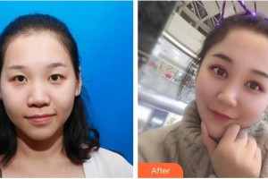 咸寧愛爾眼科醫(yī)院黃玉嬋整形價格表附眼部綜合案例展示