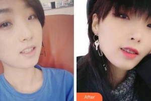 咸寧民生中山口腔醫(yī)院許炎標(biāo)整形價(jià)格表附金屬托槽矯正案例展示